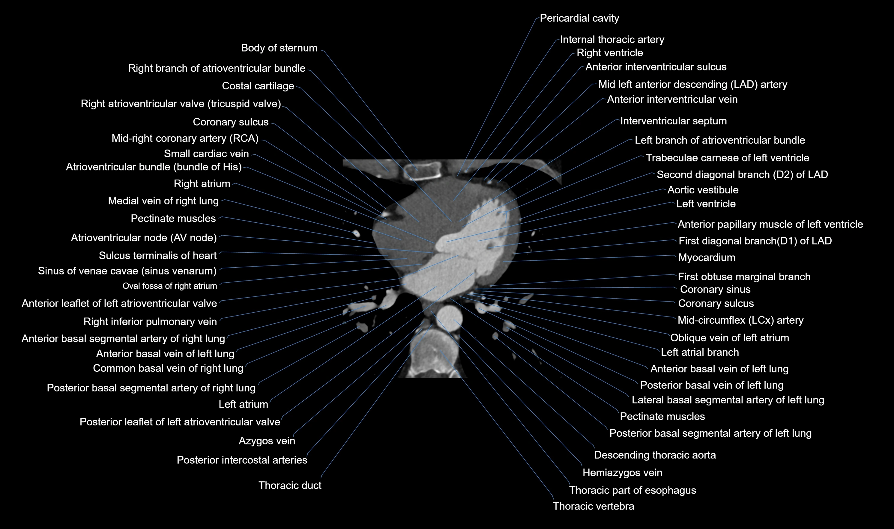 CT heart (coronary angiogram) axial view cross sectional anatomy labelled radiology image-00038.webp